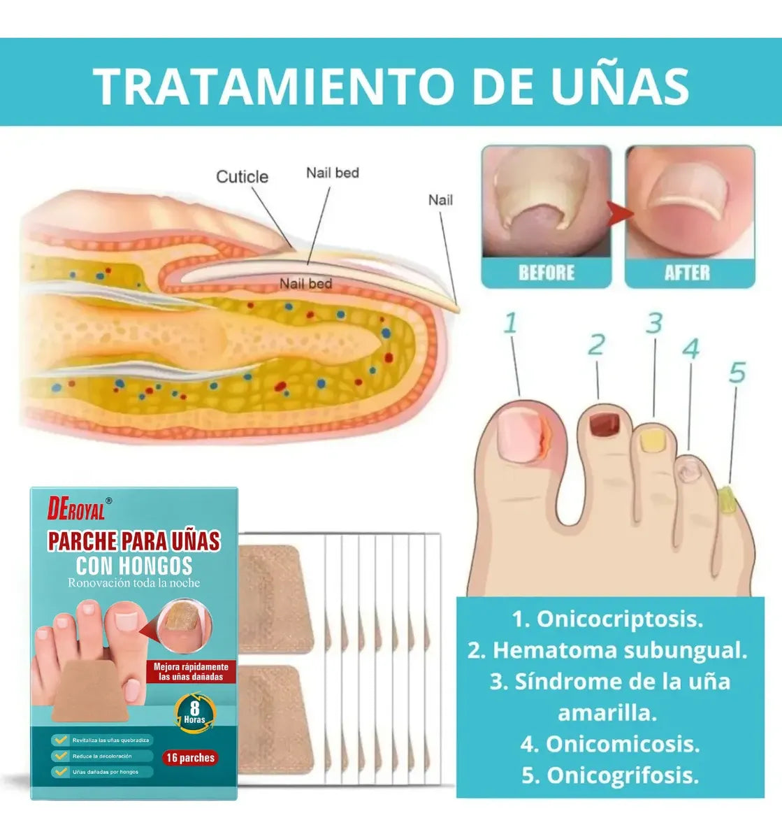 Parches antihongos para uñas